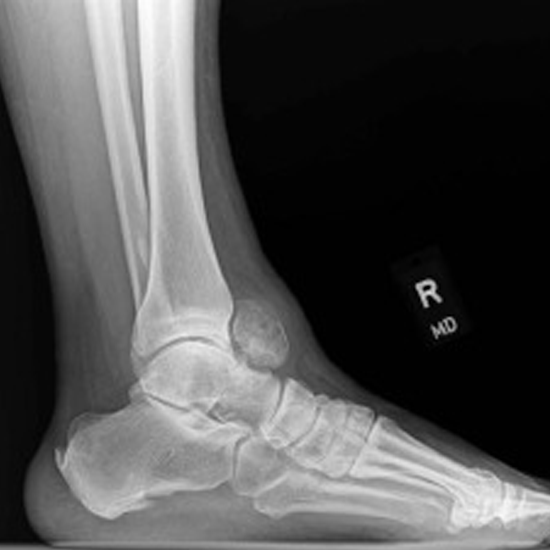 NCCT Left Ankle Joint